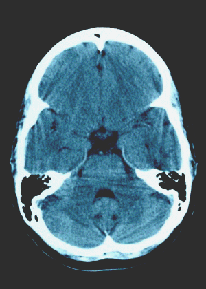 CT scan of basil ganglia